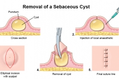 Sebacious cyst removal